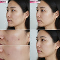 Before and after comparison of a woman's face with acne treatment showing visible improvement.